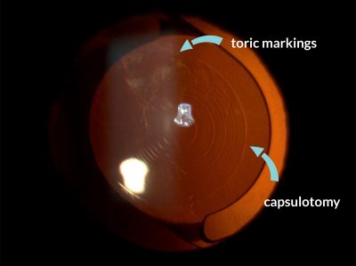 IOLcapsular-bag4 IOLcapsular-bag4