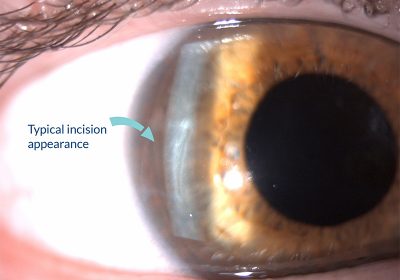 RLE-Week-1-Cornea RLE-Week-1-Cornea