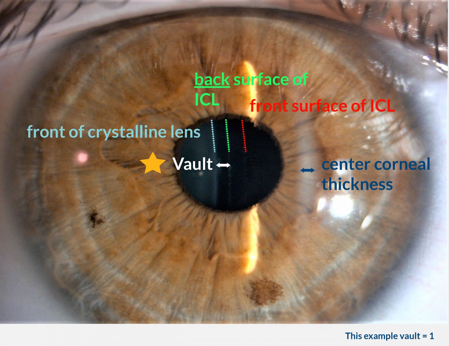 All About ICL – Clarity Portal
