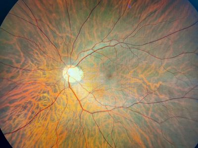 Posterior-Pole-Exam11