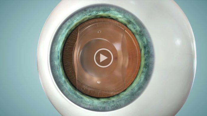 evo-procedure-animation